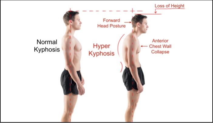 Kyphosis - Normal vs Hyper