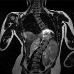 MRI of Scoliosis from Chairi