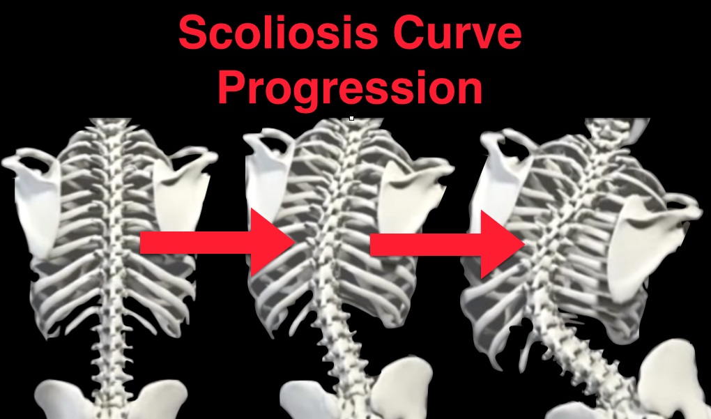 Scoliosis Curve Progression