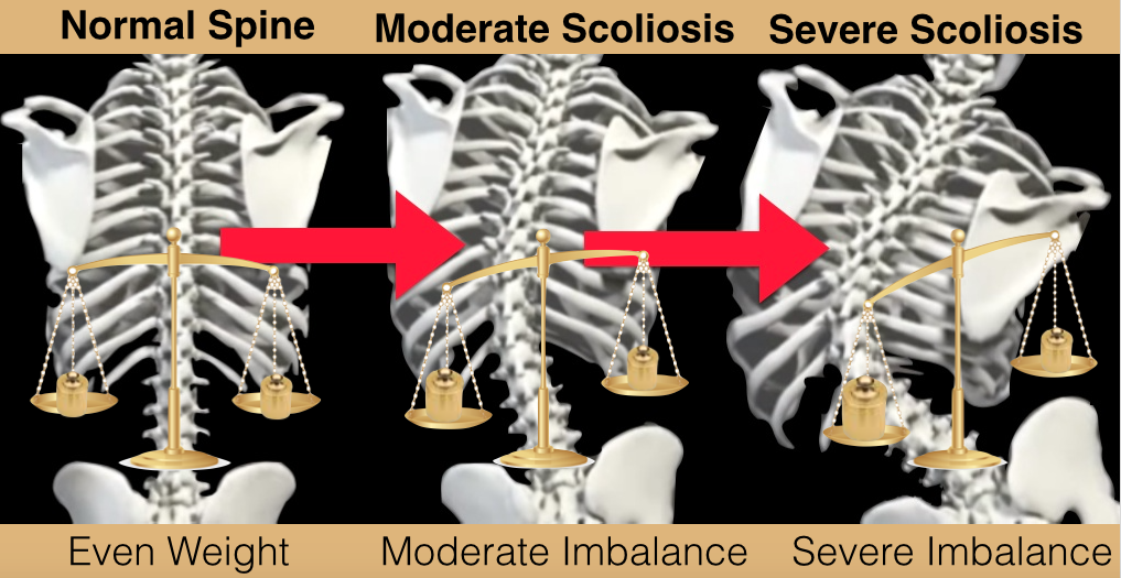 Scoliosis Weight Imbalances