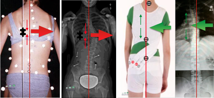 SpineCor Dynamic Orthosis - A Corrective Movement Therapy Device