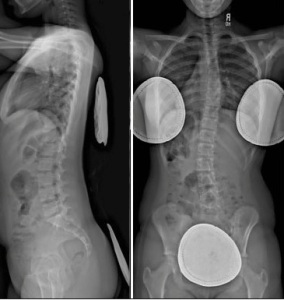 X-rays of Scoliosis AP and Lat