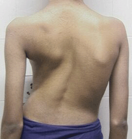 Scoliosis Rib Cage Deformity