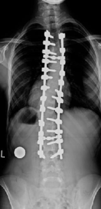 X-ray of Scoliosis Surgery With Rods