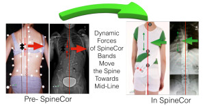 SpineCor Moves Body Towards Midline